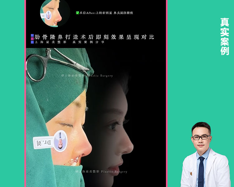 上海刘超峰医生肋骨鼻综合案例
