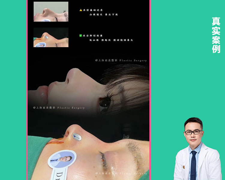 上海刘超峰院长鼻综合案例